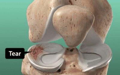 Meniscus Tears and How We Rehabilitate Them Using Physio